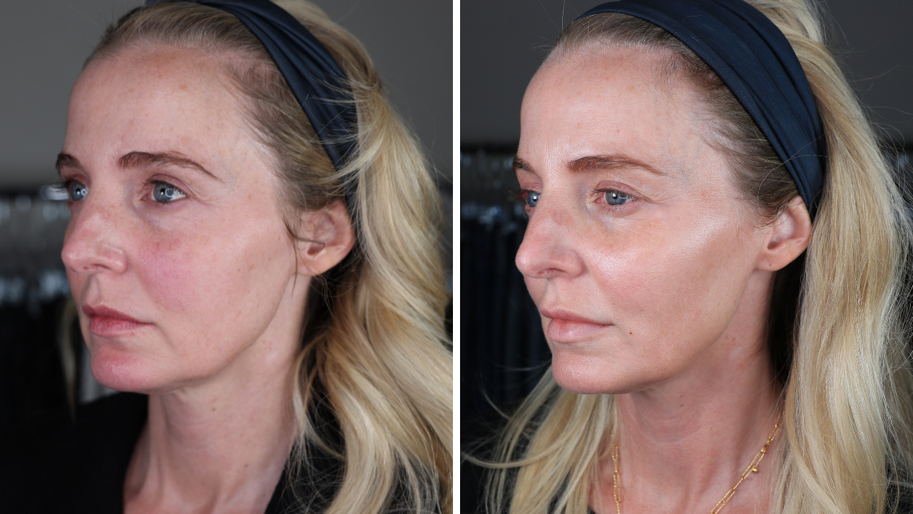 pdo thread lift, botox, lip fillers, ultherapy, ultherapy review, pdo thread lift review, look 10 years younger 