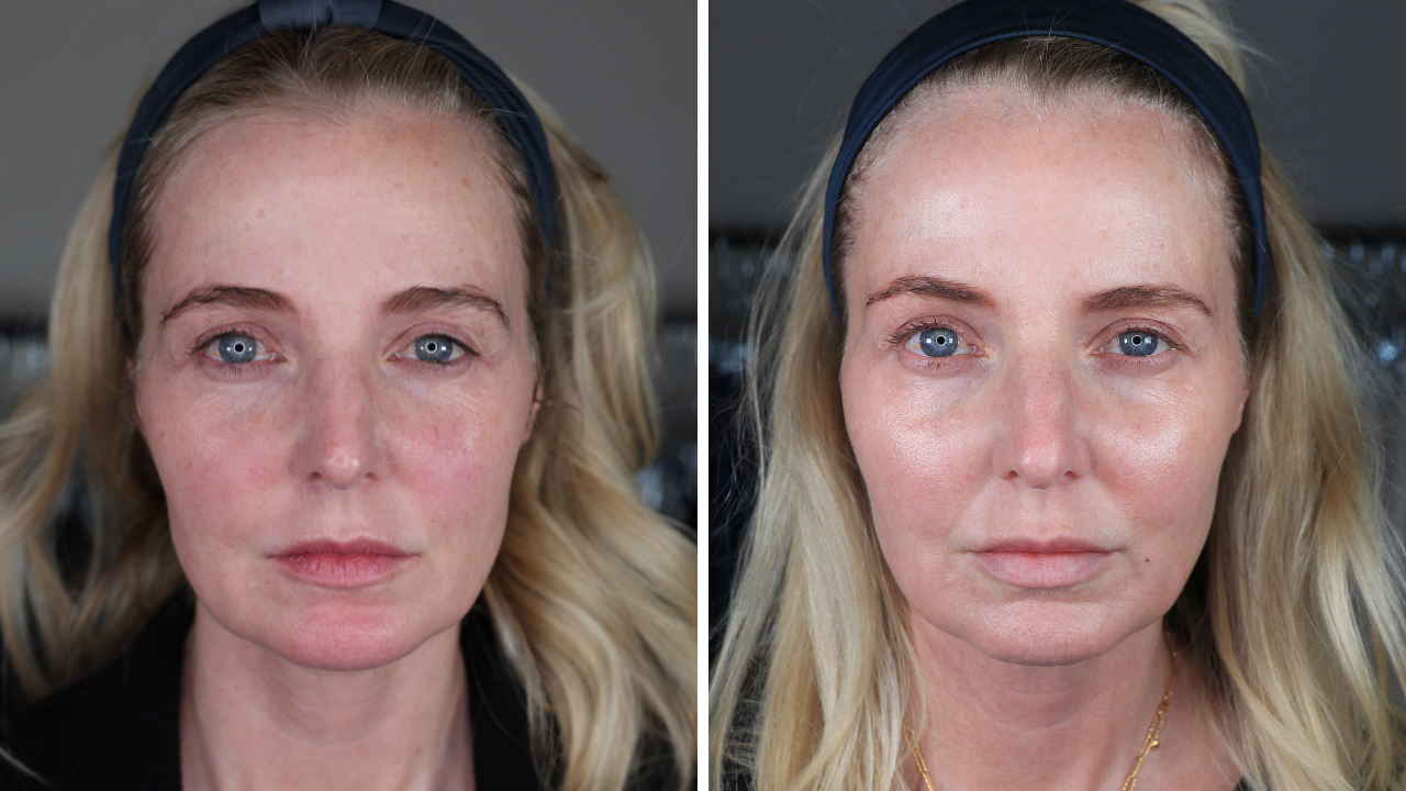 pdo thread lift, botox, lip fillers, ultherapy, ultherapy review, pdo thread lift review, look 10 years younger 