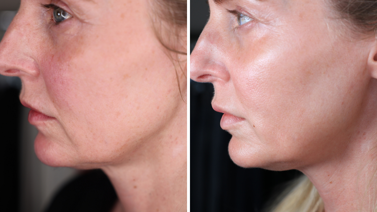 pdo thread lift, botox, lip fillers, ultherapy, ultherapy review, pdo thread lift review, look 10 years younger 