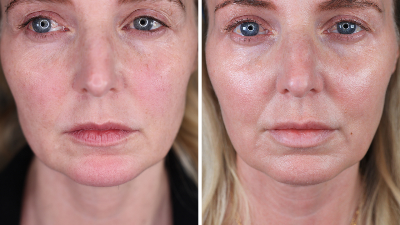 pdo thread lift, botox, lip fillers, ultherapy, ultherapy review, pdo thread lift review, look 10 years younger 