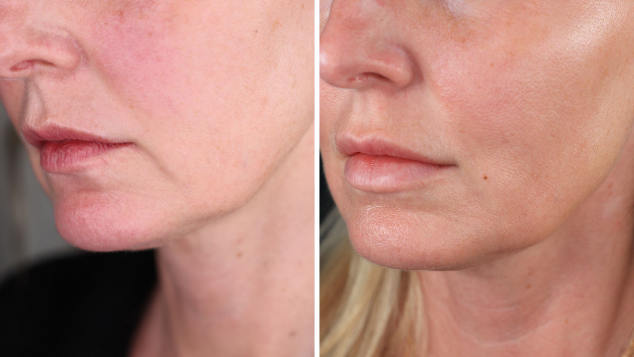 pdo thread lift, botox, lip fillers, ultherapy, ultherapy review, pdo thread lift review, look 10 years younger 