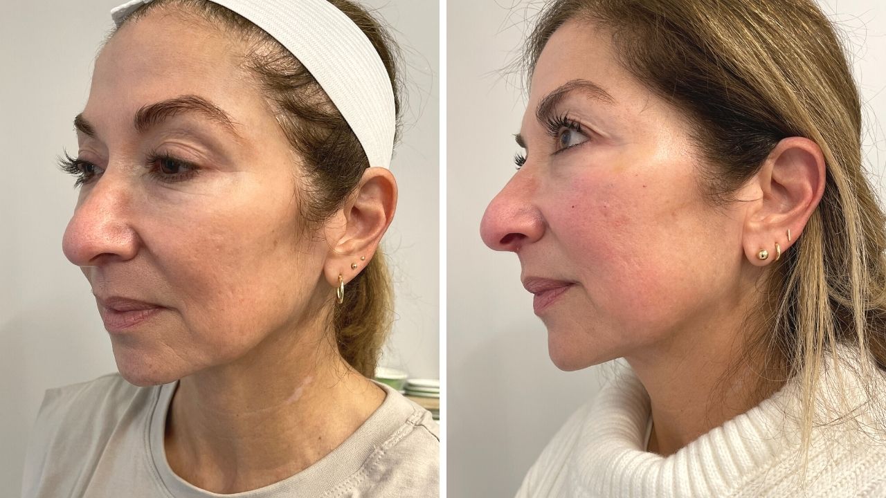 Ultherapy review Francine left view before and after, ultherpay results, ultherapy questions, procedures for younger looking skin, younger skin for women over 40