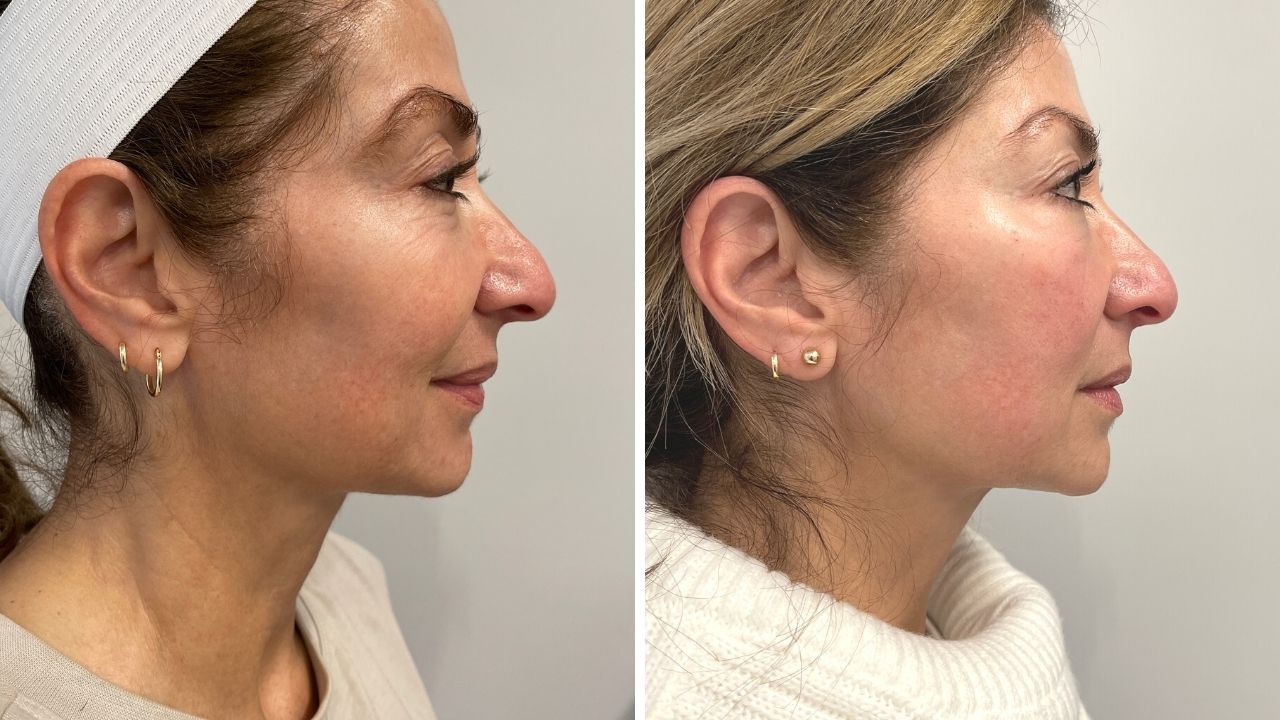 Ultherapy review Francine left view before and after, ultherpay results, ultherapy questions, procedures for younger looking skin, younger skin for women over 40